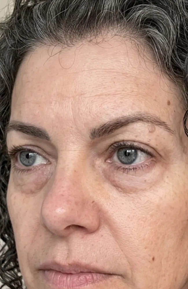What Causes Eye Bags and Puffy Under-Eyes (And What Actually Reduces Them)